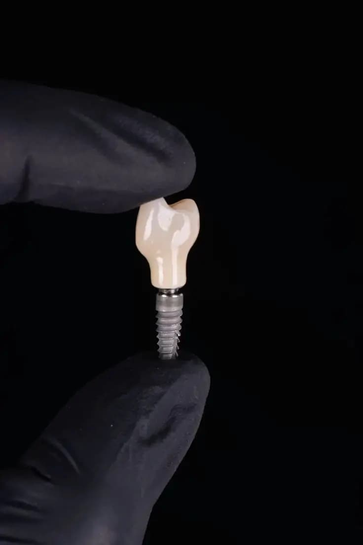 Implants dentaires à Rabat : le guide complet pour retrouver un sourire fonctionnel